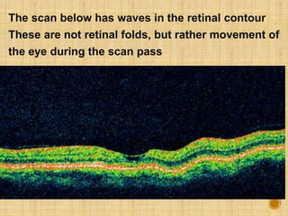 The scan below has waves in the retinal contour
These are not retinal folds, but rather movement of
the eye during the scan pass
 