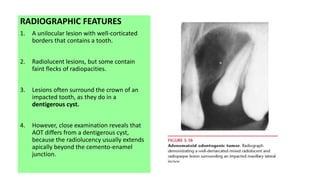 Aot Radiograph Odontogenic Tumors Oral Pathology | PPTX