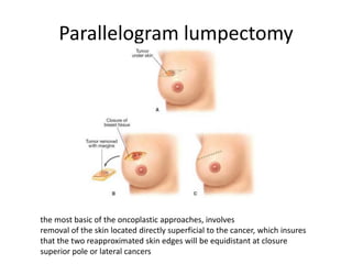 Parallelogram lumpectomy
the most basic of the oncoplastic approaches, involves
removal of the skin located directly superficial to the cancer, which insures
that the two reapproximated skin edges will be equidistant at closure
superior pole or lateral cancers
 