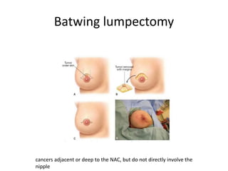 Batwing lumpectomy
cancers adjacent or deep to the NAC, but do not directly involve the
nipple
 