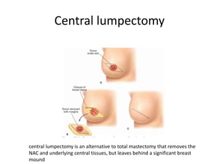 Central lumpectomy
central lumpectomy is an alternative to total mastectomy that removes the
NAC and underlying central tissues, but leaves behind a significant breast
mound
 