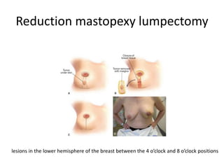 Reduction mastopexy lumpectomy
lesions in the lower hemisphere of the breast between the 4 o’clock and 8 o’clock positions
 