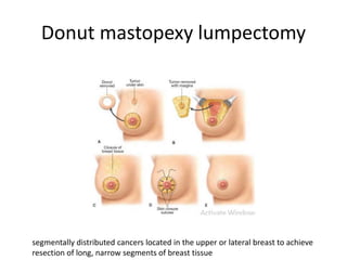 Donut mastopexy lumpectomy
segmentally distributed cancers located in the upper or lateral breast to achieve
resection of long, narrow segments of breast tissue
 