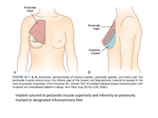 Implant sutured to pectoralis muscle superiorly and inferiorly to previously
marked or designated inframammary fold
 