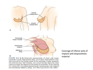 Coverage of inferior pole of
implant with bioprosthetic
material
 