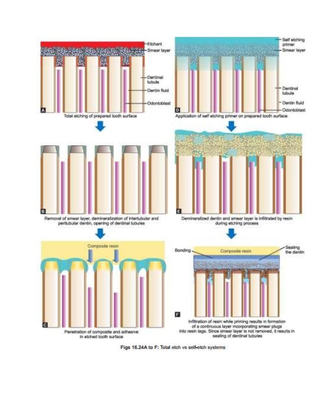 Bonding to Enamel and Dentin Bonding to Enamel and Dentin