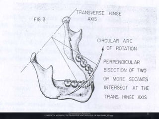 LAWRENCEA. WEINBERG, THE TRANSVERSE HINGEAXIS: REAL OR IMAGINARY,JPD 1959
Orientation Relation 11
 