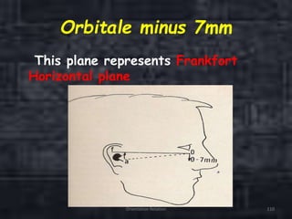 Orbitale minus 7mm
This plane represents Frankfort
Horizontal plane
Orientation Relation 110
 