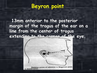 Beyron point
13mm anterior to the posterior
margin of the tragus of the ear on a
line from the center of tragus
extending to the corner of the eye.
Orientation Relation 95
 