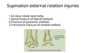 Talus Rotation Injuries fractures of leg foot and kneee | PPTX