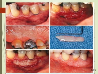 1. CLASSICAL TECHNIQUE
9/25
 
