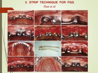 3. STRIP TECHNIQUE FOR FGG
Han et al
 