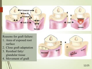 Reasons for graft failure:
1. Area of exposed root
surface
2. Close graft adaptation
3. Residual fatty/
glandular tissue
4. Movement of graft
12/25
 