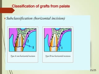 Classification of grafts from palate
 Liu classification (2002)
Class I: One incision line
Class II: Two incision lines (L Shape)
Class III: Three incision lines (U shape)
Subclassification (horizontal incision)
Type A: one horizontal incision Type B: two horizontal incisions
15/25
 