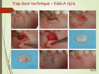 Trap door technique – Edel.A 1974
16/25
 