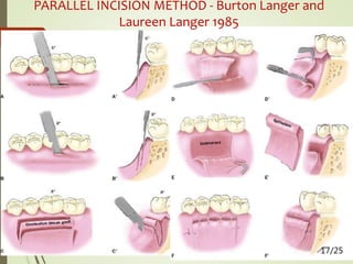 PARALLEL INCISION METHOD - Burton Langer and
Laureen Langer 1985
17/25
 