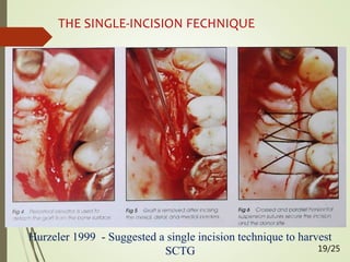 THE SINGLE-INCISION FECHNIQUE
Hurzeler 1999 - Suggested a single incision technique to harvest
SCTG 19/25
 