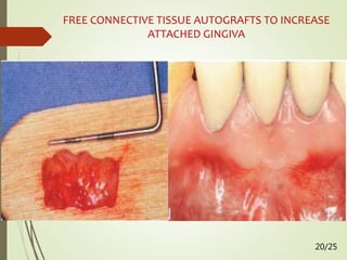 FREE CONNECTIVE TISSUE AUTOGRAFTS TO INCREASE
ATTACHED GINGIVA
20/25
 
