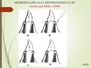 MODIFIED APICALLY REPOSITIONED FLAP
Carnio and Miller (1999)
24/25
 