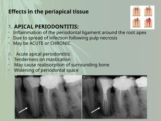 Effects in the periapical tissue
1. APICAL PERIODONTITIS:
• Inflammation of the periodontal ligament around the root apex
• Due to spread of infection following pulp necrosis
• May be ACUTE or CHRONIC
A. Acute apical periodontitis:
• Tenderness on mastication
• May cause reabsorption of surrounding bone
• Widening of periodontal space
 