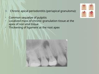 B. Chronic apical periodontitis (periapical granuloma):
• Common sequelae of pulpitis
• Localized mass of chronic granulation tissue at the
apex of non vital tissue
• Thickening of ligament at the root apex
 