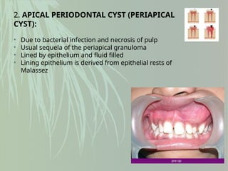 2. APICAL PERIODONTAL CYST (PERIAPICAL
CYST):
• Due to bacterial infection and necrosis of pulp
• Usual sequela of the periapical granuloma
• Lined by epithelium and fluid filled
• Lining epithelium is derived from epithelial rests of
Malassez
 