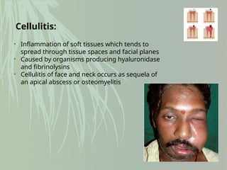 Cellulitis:
• Inflammation of soft tissues which tends to
spread through tissue spaces and facial planes
• Caused by organisms producing hyaluronidase
and fibrinolysins
• Cellulitis of face and neck occurs as sequela of
an apical abscess or osteomyelitis
 