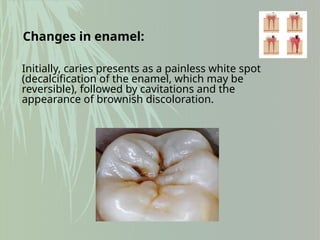 Initially, caries presents as a painless white spot
(decalcification of the enamel, which may be
reversible), followed by cavitations and the
appearance of brownish discoloration.
Changes in enamel:
 