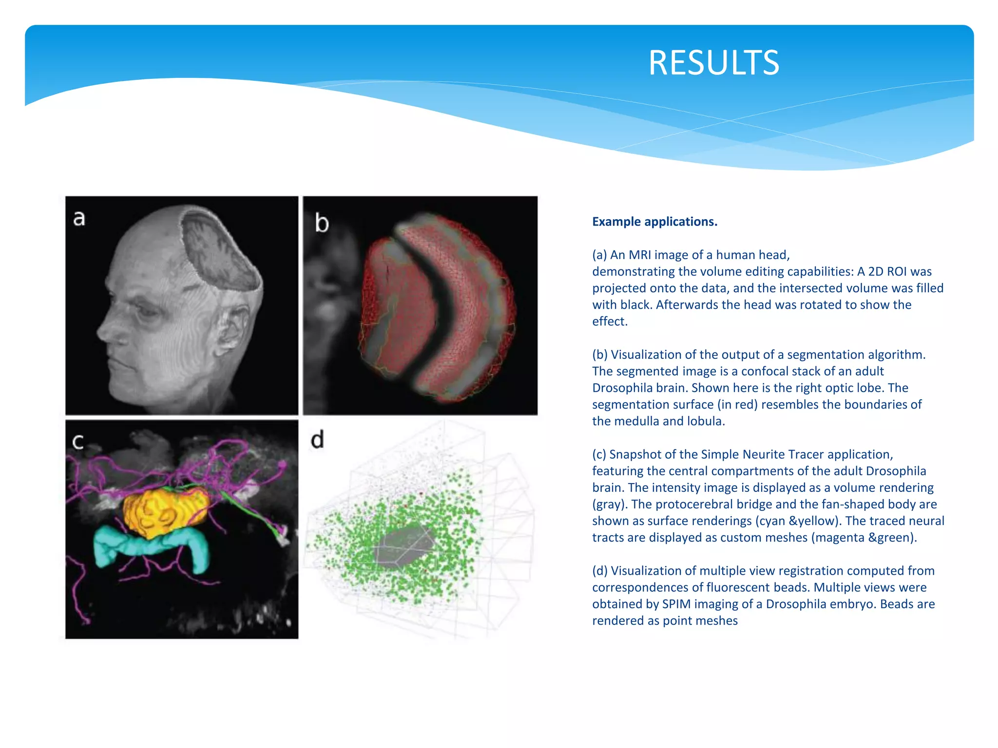 RESULTS


Example applications.

(a) An MRI image of a human head,
demonstrating the volume editing capabilities: A 2D ROI was
projected onto the data, and the intersected volume was filled
with black. Afterwards the head was rotated to show the
effect.

(b) Visualization of the output of a segmentation algorithm.
The segmented image is a confocal stack of an adult
Drosophila brain. Shown here is the right optic lobe. The
segmentation surface (in red) resembles the boundaries of
the medulla and lobula.

(c) Snapshot of the Simple Neurite Tracer application,
featuring the central compartments of the adult Drosophila
brain. The intensity image is displayed as a volume rendering
(gray). The protocerebral bridge and the fan-shaped body are
shown as surface renderings (cyan &yellow). The traced neural
tracts are displayed as custom meshes (magenta &green).

(d) Visualization of multiple view registration computed from
correspondences of fluorescent beads. Multiple views were
obtained by SPIM imaging of a Drosophila embryo. Beads are
rendered as point meshes
 