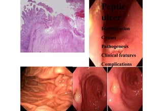 Peptic
ulcer
Identification
Causes
Pathogenesis
Clinical features
Complications
 