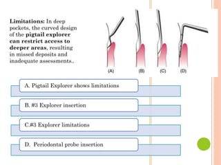 Limitations: In deep
pockets, the curved design
of the pigtail explorer
can restrict access to
deeper areas, resulting
in missed deposits and
inadequate assessments..
A. Pigtail Explorer shows limitations
B. #3 Explorer insertion
C.#3 Explorer limitations
D. Periodontal probe insertion
 