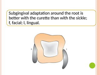 Subgingival adaptation around the root is
better with the curette than with the sickle;
f, facial; l, lingual.
 