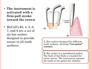 A, Hoe scalers designed for different
tooth surfaces, showing “two-point”
contact.
B, Hoe scaler in a periodontal pocket.
The back of the blade is rounded for
easier access. The instrument contacts
the tooth at two points for stability
• The instrument is
activated with a
firm pull stroke
toward the crown
• McCall’s #3, 4, 5, 6,
7, and 8 are a set of
six hoe scalers
designed to provide
access to all tooth
surfaces.
 