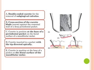 A, Double-ended curette for the
removal of subgingival calculus.
B, Cross-section of the curette
blade (arrow) against the cemental
wall of a deep periodontal pocket.
C, Curette in position at the base of a
periodontal pocket on the facial
surface of a mandibular molar.
D, Curette inserted in a pocket with
the tip directed apically.
E, Curette in position at the base of a
pocket on the distal surface of the
mandibular molar.
 