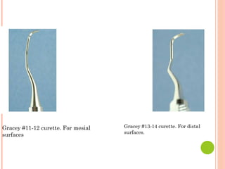 Gracey #13-14 curette. For distal
surfaces.
Gracey #11-12 curette. For mesial
surfaces
 