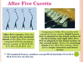 After Five curette. Note the
extra 3 mm in the terminal
shank of the After Five curette
compared with the standard
Gracey curette. A, #5-6; B, #7-
8; C, #11-12; D, #13- 14.)
Comparison of After Five curette with
standard Gracey curette. Rigid Gracey
#13-14 adapted to the distal surface of
the first molar and rigid After Five
#13-14 adapted to the distal surface of
the second molar. Notice the extralong
shank of the After Five curette, which
allows deeper insertion and better
access
▪ All standard Gracey numbers except #9-10 (includes #1-2, #3-4,
#5-6, #7-8, #11-12, #13-14).
After Five Curette
 