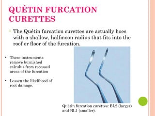 QUÉTIN FURCATION
CURETTES
○ The Quétin furcation curettes are actually hoes
with a shallow, halfmoon radius that fits into the
roof or floor of the furcation.
Quétin furcation curettes: BL2 (larger)
and BL1 (smaller).
• These instruments
remove burnished
calculus from recessed
areas of the furcation
• Lessen the likelihood of
root damage.
 