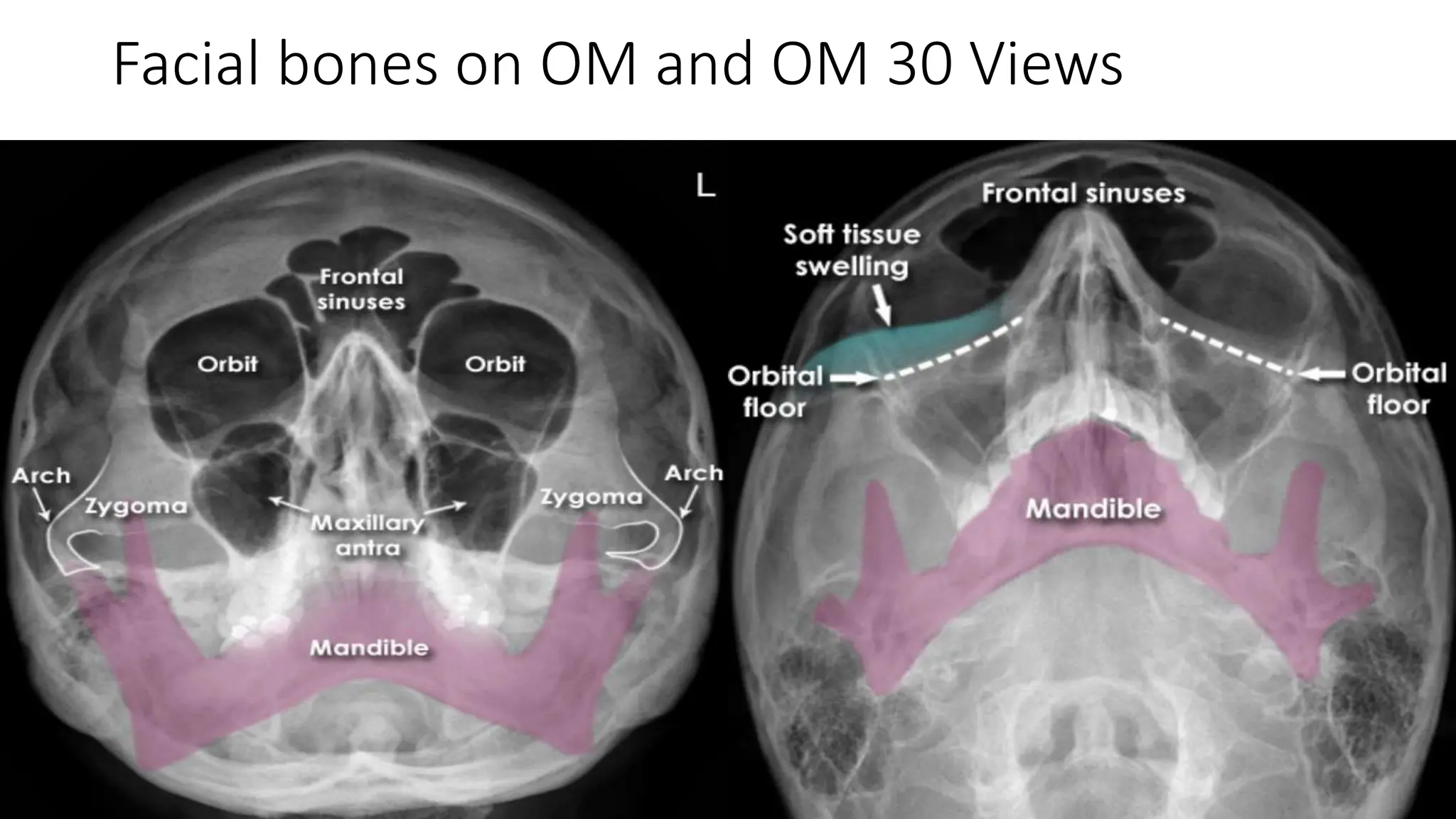 Normal Pns View Overview of Paranasal sinus Radiology.pptx