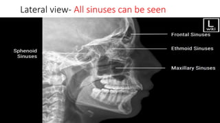 Normal Pns View Overview of Paranasal sinus Radiology.pptx