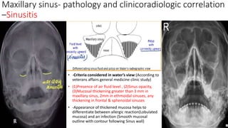 Overview of Paranasal sinus Radiology.pptx