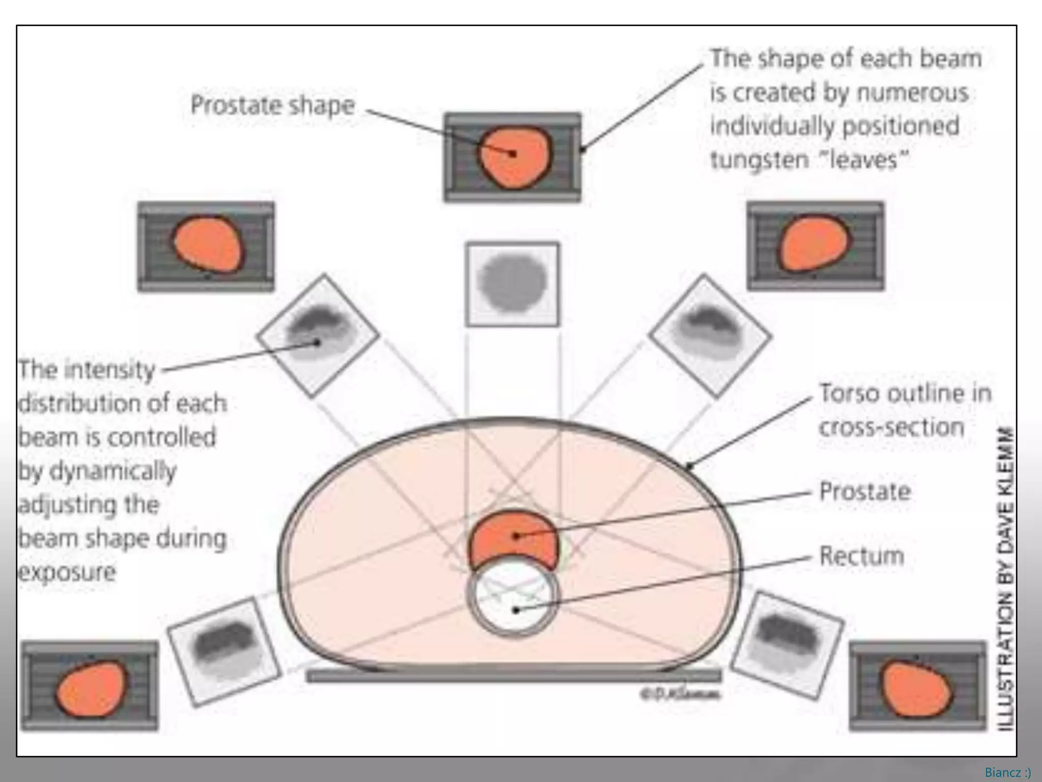 Radiation Therapy - Prostate Cancer | PPTX