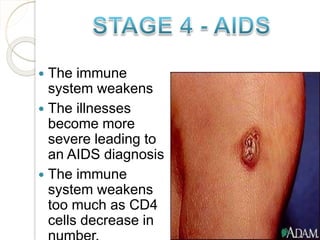  The immune
system weakens
 The illnesses
become more
severe leading to
an AIDS diagnosis
 The immune
system weakens
too much as CD4
cells decrease in
 