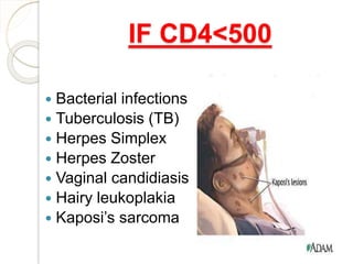 Bacterial infections
 Tuberculosis (TB)
 Herpes Simplex
 Herpes Zoster
 Vaginal candidiasis
 Hairy leukoplakia
 Kaposi’s sarcoma
IF CD4<500
 