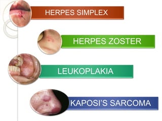 HERPES SIMPLEX
HERPES ZOSTER
LEUKOPLAKIA
KAPOSI’S SARCOMA
 