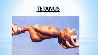 TETANUS
 
