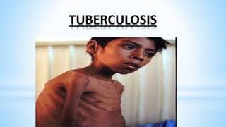 TUBERCULOSIS
 