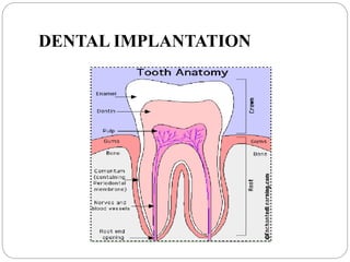DENTAL IMPLANTATION
 
