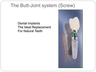 The Butt-Joint system (Screw)
Dental Implants
The Ideal Replacement
For Natural Teeth
 