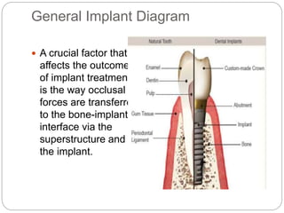 General Implant Diagram
 A crucial factor that
affects the outcome
of implant treatment
is the way occlusal
forces are transferred
to the bone-implant
interface via the
superstructure and
the implant.
 
