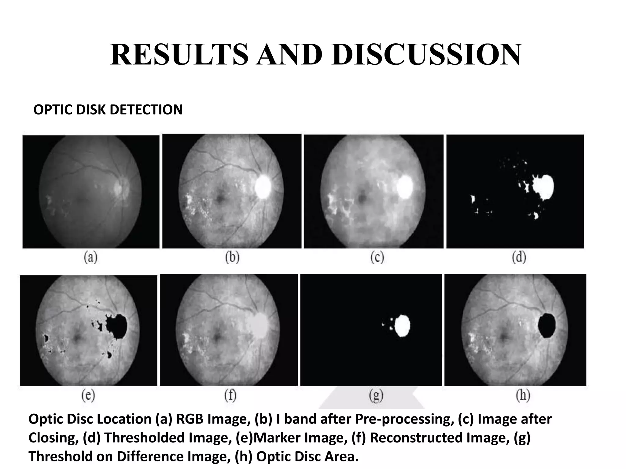 RESULTS AND DISCUSSION
OPTIC DISK DETECTION
Optic Disc Location (a) RGB Image, (b) I band after Pre-processing, (c) Image after
Closing, (d) Thresholded Image, (e)Marker Image, (f) Reconstructed Image, (g)
Threshold on Difference Image, (h) Optic Disc Area.
 